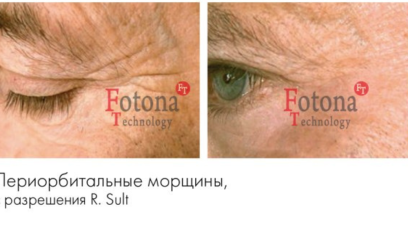 Фотона Глаза 10 Фотона Глаза 10